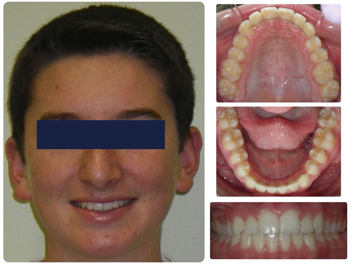 Adolescent Adult Treatment Wellington Fl Shults Orthodontics